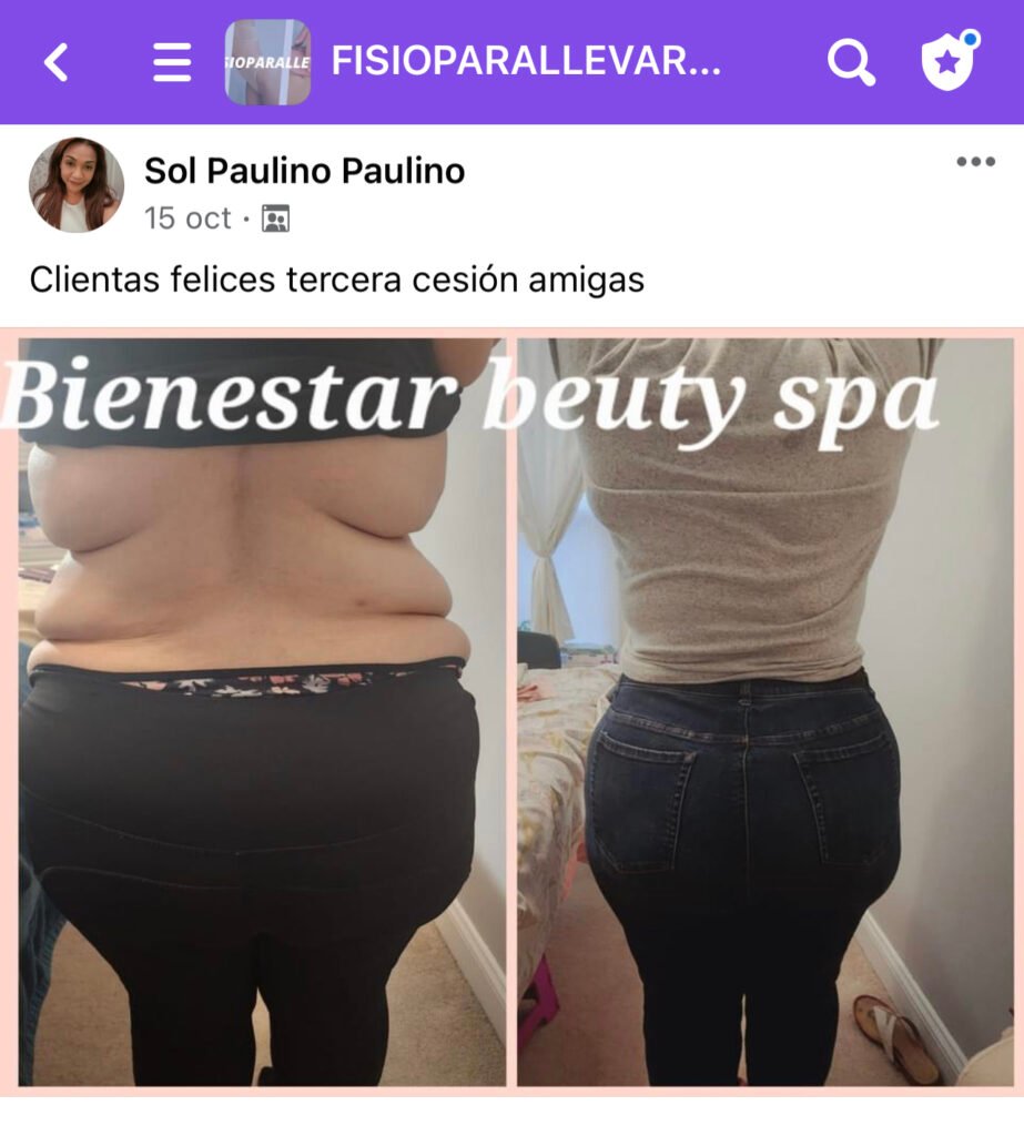 "Alumna satisfecha mostrando resultados antes y después del drenaje linfático brasileño"